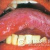 粘膜白斑病出现皮肤病的部位是哪里