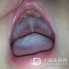 外阴粘膜白斑如何定义