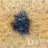 分享一下关于幼年黑素瘤的诊断方法