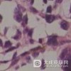 幼年黑素瘤怎么办