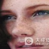 什么方法治疗雀斑比较好