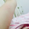 怎么预防急性荨麻疹