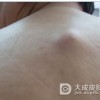 脂肪瘤的临床症状是什么？