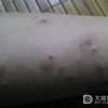 单纯痒疹护理都注意什么呢