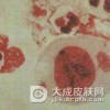 男性非淋菌性尿道炎症状有什么