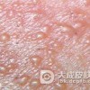 女性初期非淋菌性尿道炎是什么症状