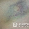 血小板减少性紫癜的护理方法有哪些