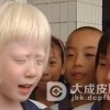 白化病的危害