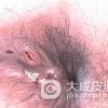 化脓性汗腺炎该如何预防呢