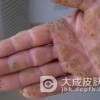 掌跖角皮病如何护理
