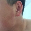 瑞尔黑变病的发展进程