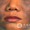 职业性黑变病及瑞尔黑变病的介绍