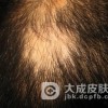 斑秃我们到底应该怎么预防