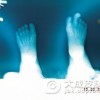 治疗趾断症的方法是什么
