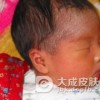 小儿脓疱疮会出现什么症状