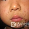 如何做好脓疱疮预防措施