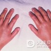 妊娠合并硬皮病诱发病因有哪些