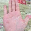 头皮湿疹治疗
