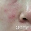 增殖性皮炎怎么治疗呢
