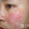 什么是Whitfield硬红斑