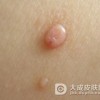 增殖性皮炎的治疗方法