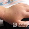 传染性湿疹样皮炎如何处理