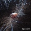 脸上长了瘊子怎么办？