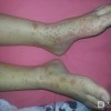 过敏性紫癜患者的饮食护理事项