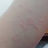出游玩要怎么预防过敏性紫癜