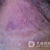 得了明癣怎么护理