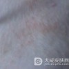 明癣患者该怎么护理呢