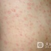 梅毒在生活中有哪些症状表现