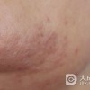 了解梅毒的传达路径避免感染