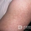 放射性皮炎的原因都有什么