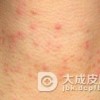放射性皮炎的病发原因是什么