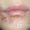 染发皮炎的护理措施是什么