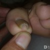 在饮食上甲沟炎患者要注意什么