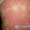 牛皮癣怎么治疗好呢