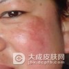 得了雀斑要怎么检查？
