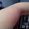 急性荨麻疹该怎样有效治疗