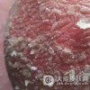 红皮病型牛皮癣的危害大吗