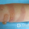 异位性皮炎的病发原因是什么？