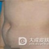 小儿患上脂肪瘤出现的症状表现