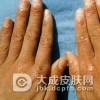 传染性湿疹样皮炎的护理