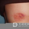 传染性湿疹样皮炎的护理方法有哪些