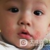 怎么护理传染性湿疹样皮炎呢