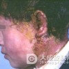 传染性湿疹样皮炎严重吗