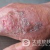 传染性湿疹样皮炎传染吗
