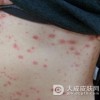 红皮病型牛皮癣会遗传吗