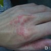 异位性皮炎的危害有哪些